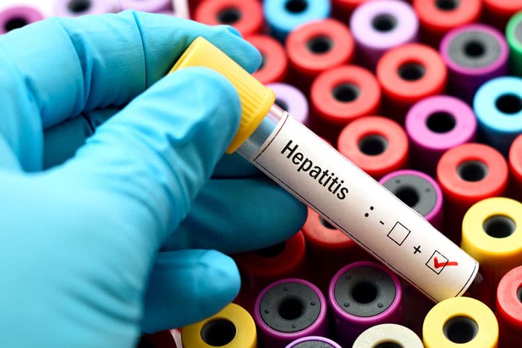 Kenali Penyebab dan Cara Pencegahan Melawan Hepatitis